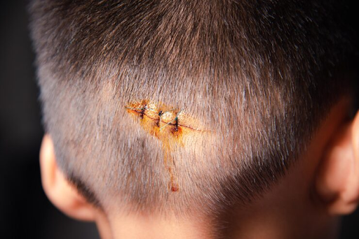 How Hair Transplants for Scars Differ from Standard Procedures